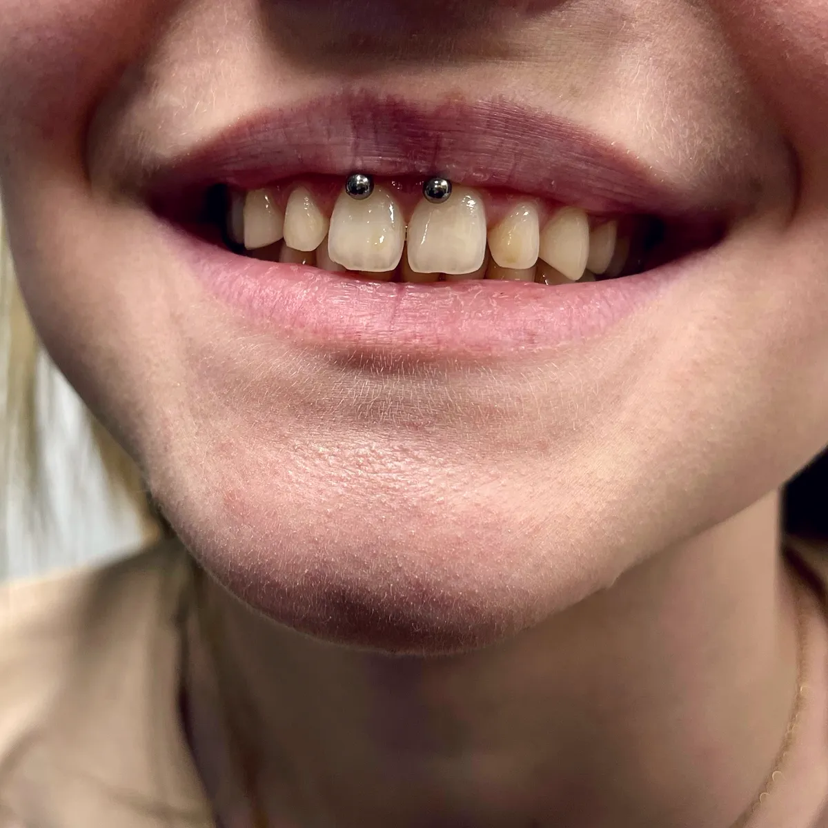 Tout savoir sur le piercing smiley, photo 5 sur 10